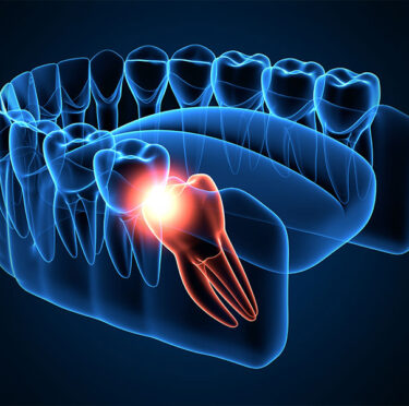 Understanding The Process Of Wisdom Teeth Removal