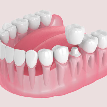 What You Should Know About Dental Crowns?