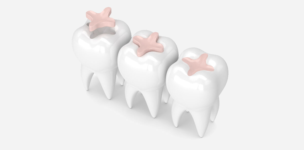 Everything You Need to Know About Composite Fillings