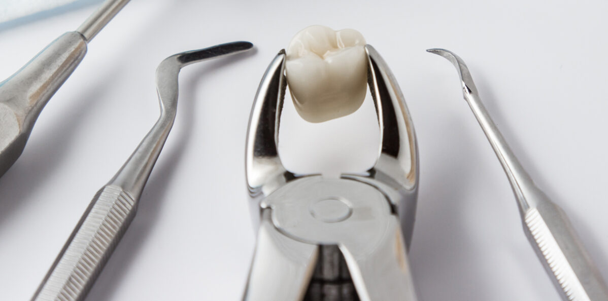 Do’s and Don’ts After Wisdom Teeth Removal
